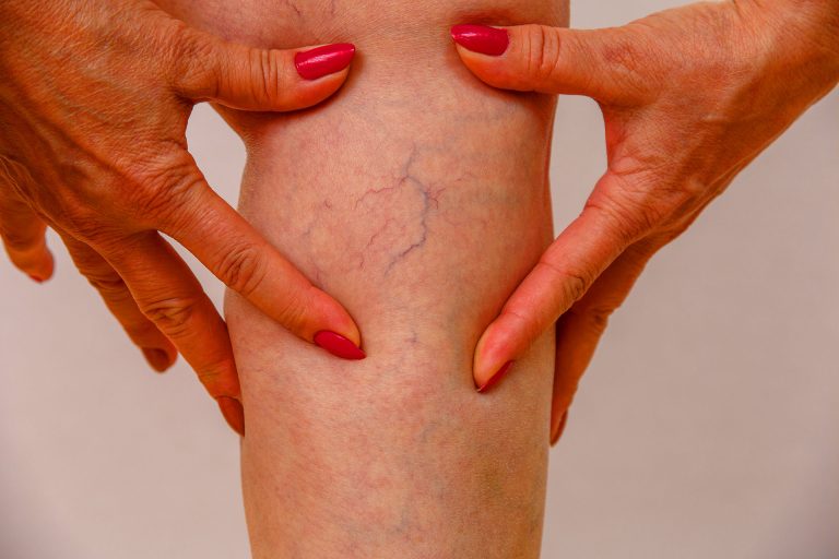 Spider Veins Treatments