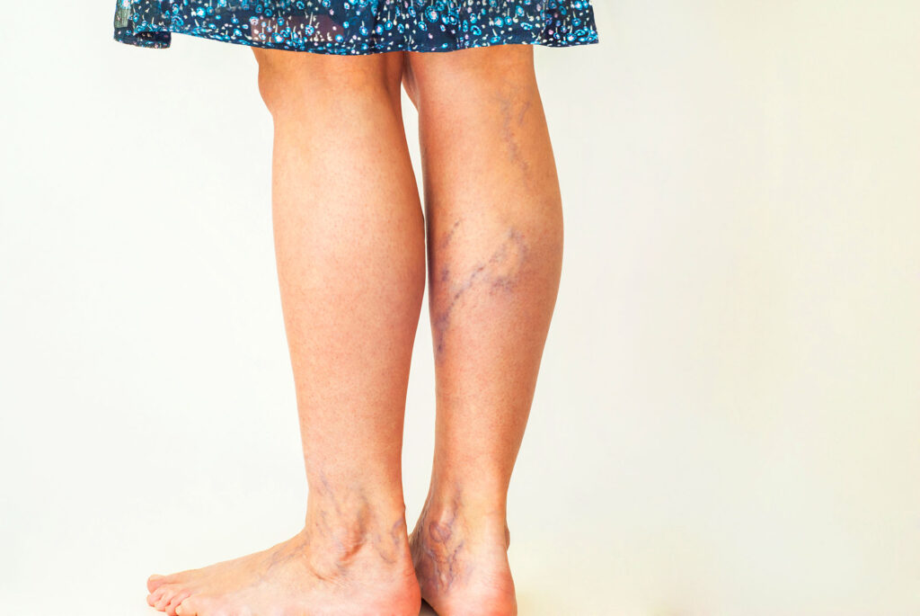 green blue veins on leg