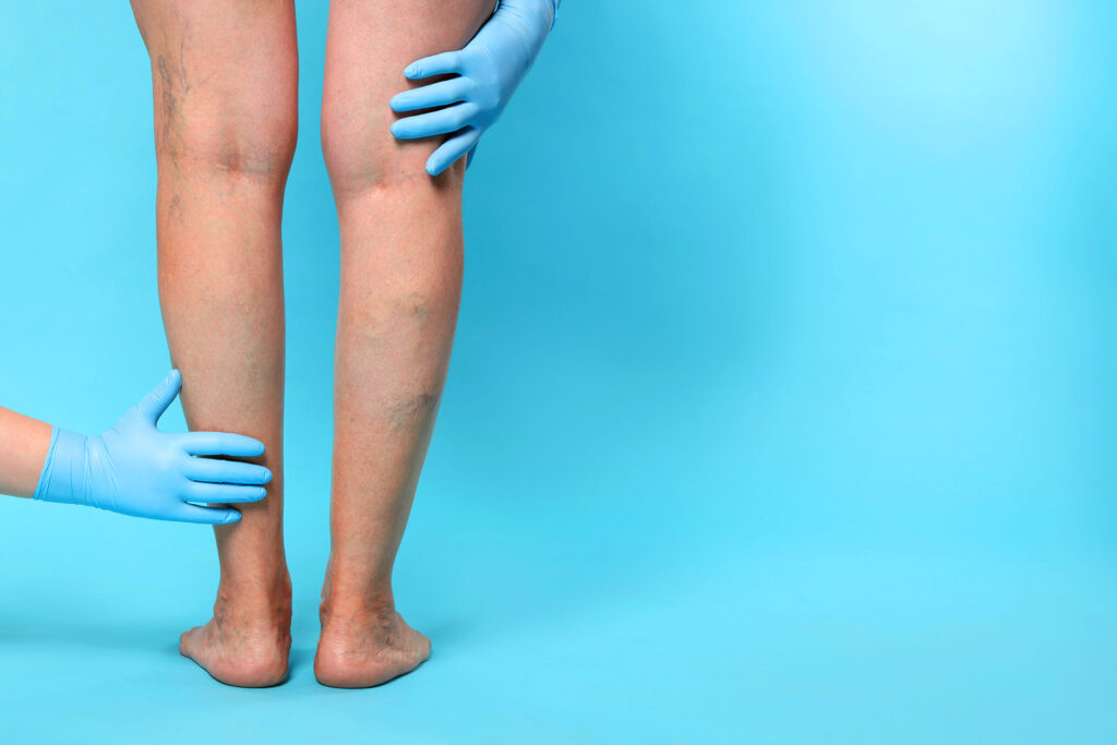 leg with visible veins