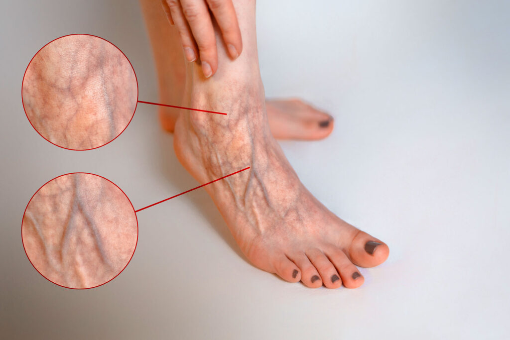 blue veins on leg