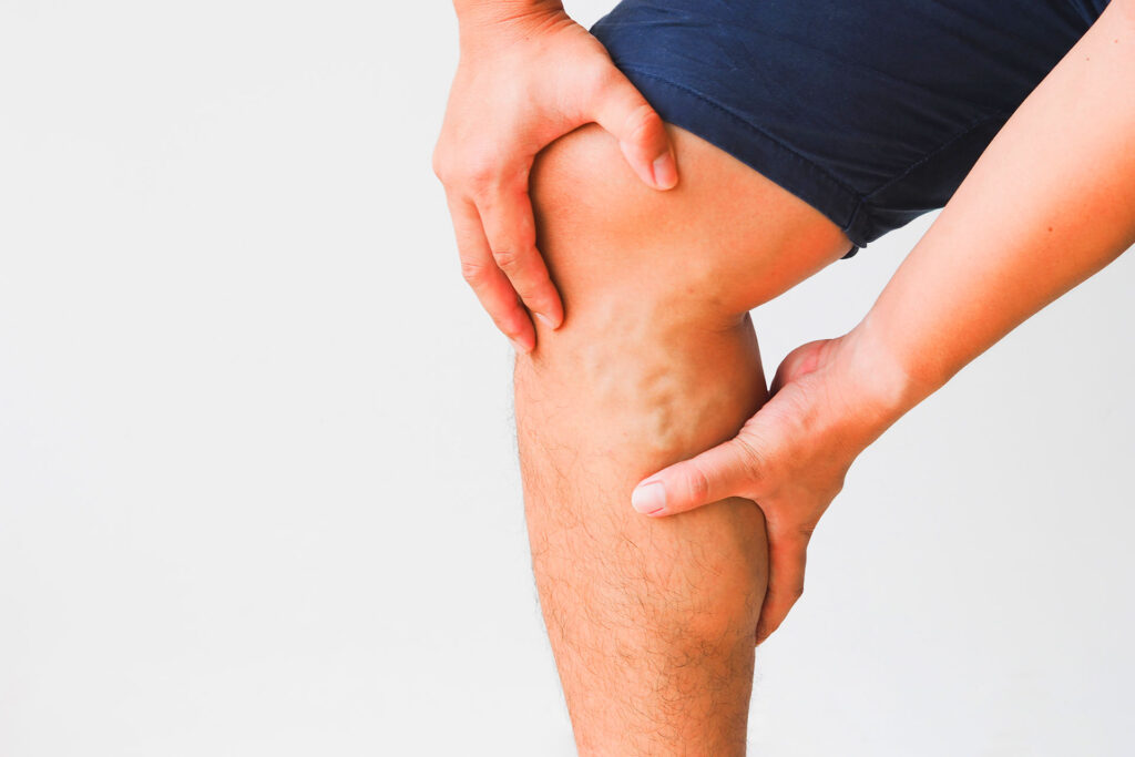 A close-up of a person holding their lower leg and knee, highlighting prominent veins.