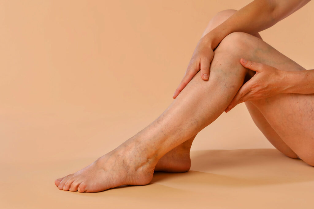 A side view of a person sitting down and gently holding their lower leg, showcasing visible superficial veins.
