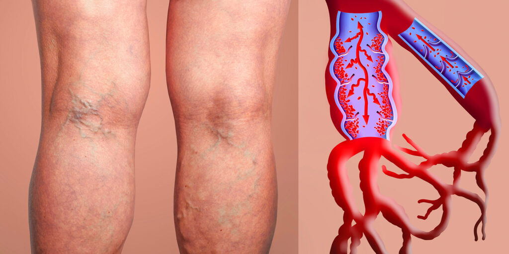 A split-image view comparing human legs with visible veins on the left to an anatomical illustration of a vein with malfunctioning valves on the right.