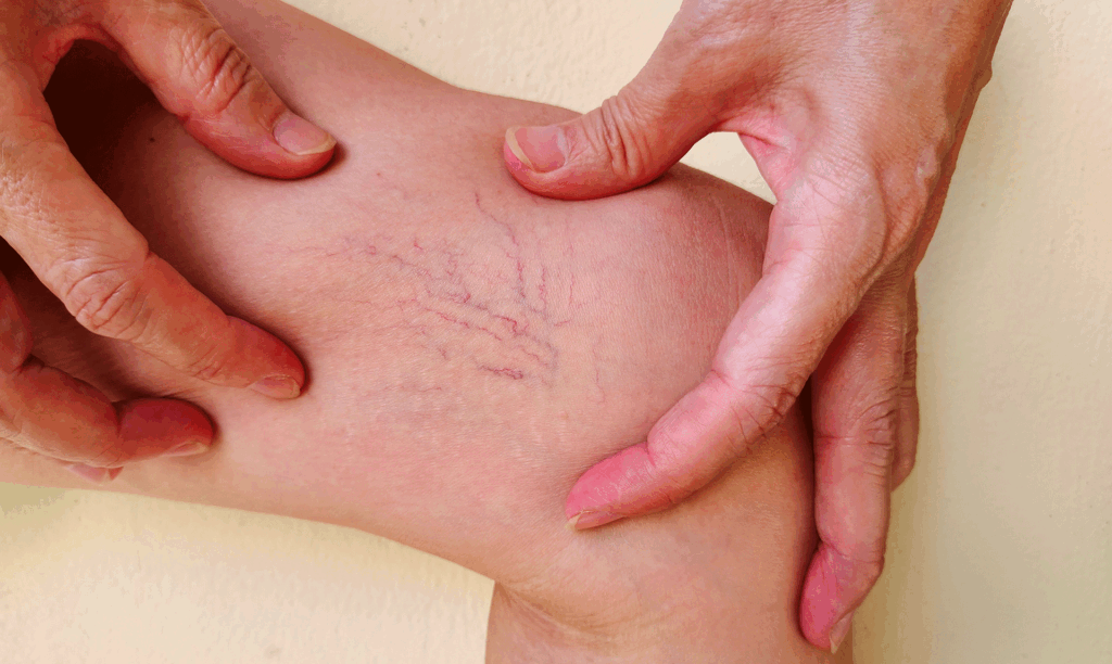 Close-up of hands examining visible spider veins or vascular issues on a leg.